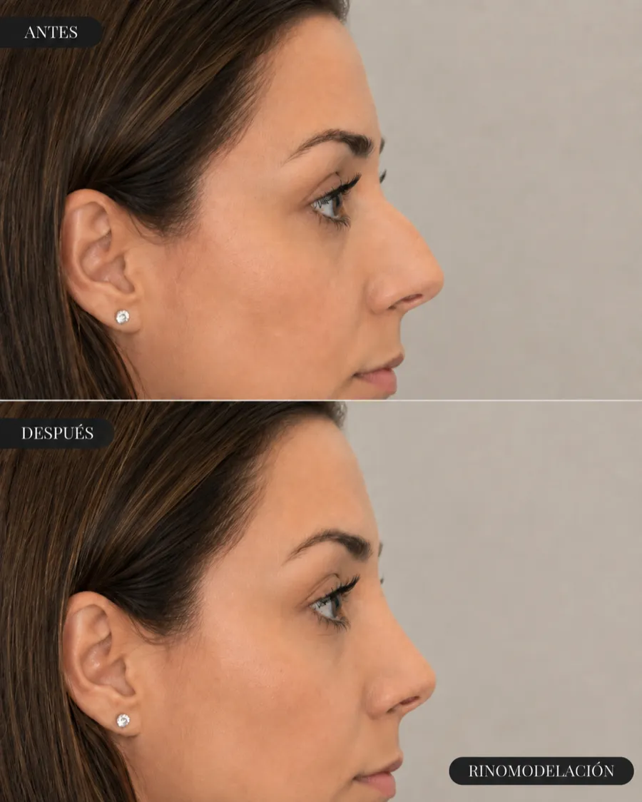 Antes y después de una rinomodelación con ácido hialurónico, vista de perfil